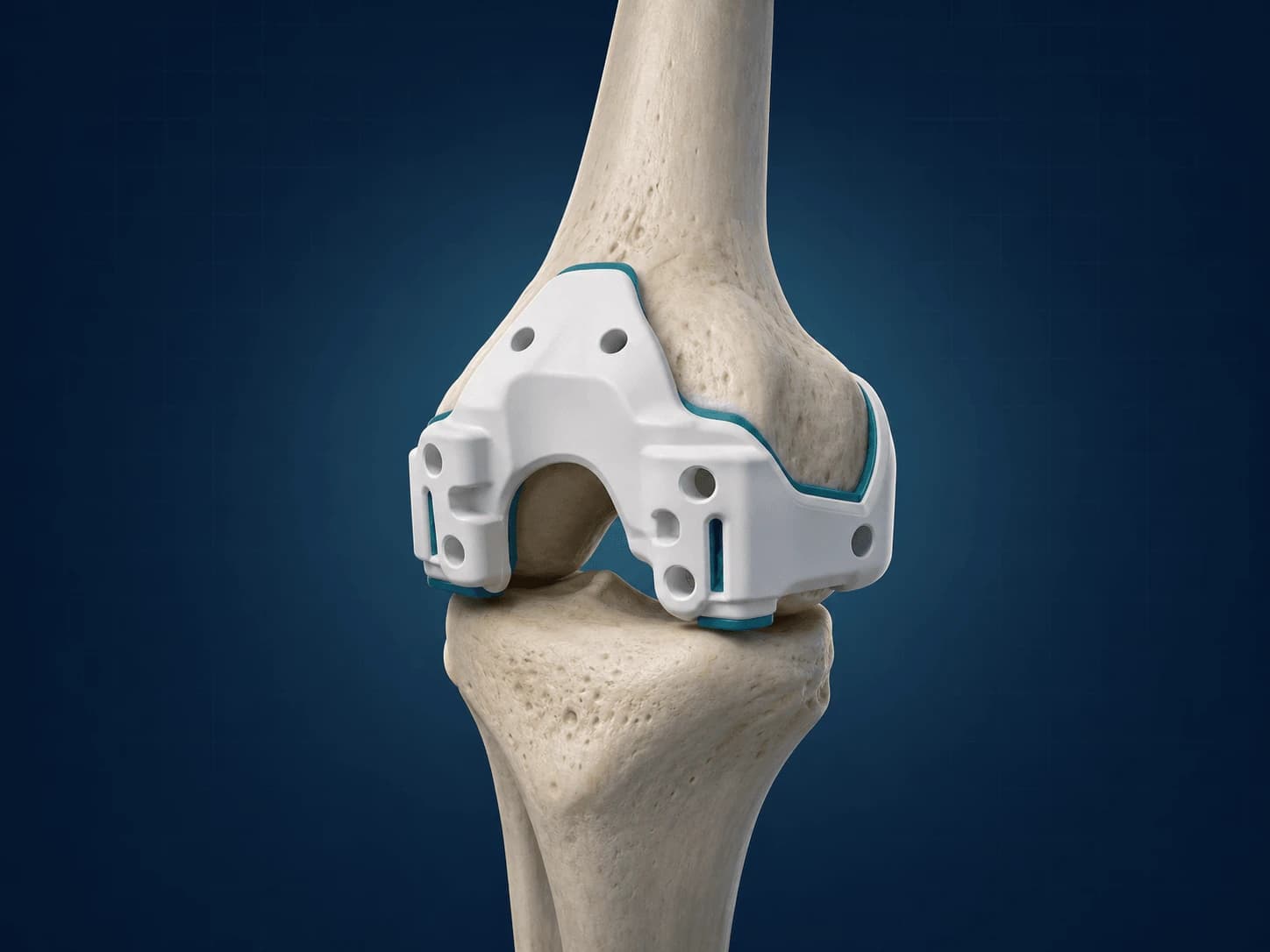 Diz anatomisi üzerinde kişiye özel kesi bloğu