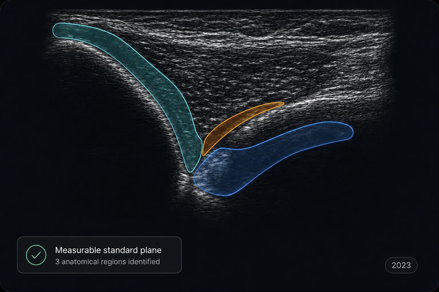 Mask R-CNN ile üç anatomik bölgenin segmentasyonu — 2023 çalışması
